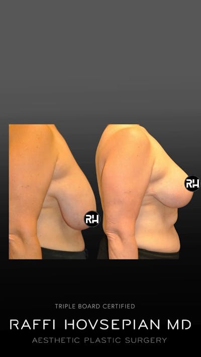 Procedures Before & After Gallery - Patient 269115 - Image 1
