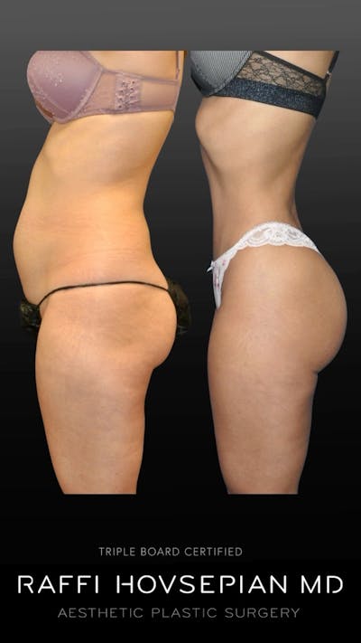 Procedures Before & After Gallery - Patient 246737 - Image 1