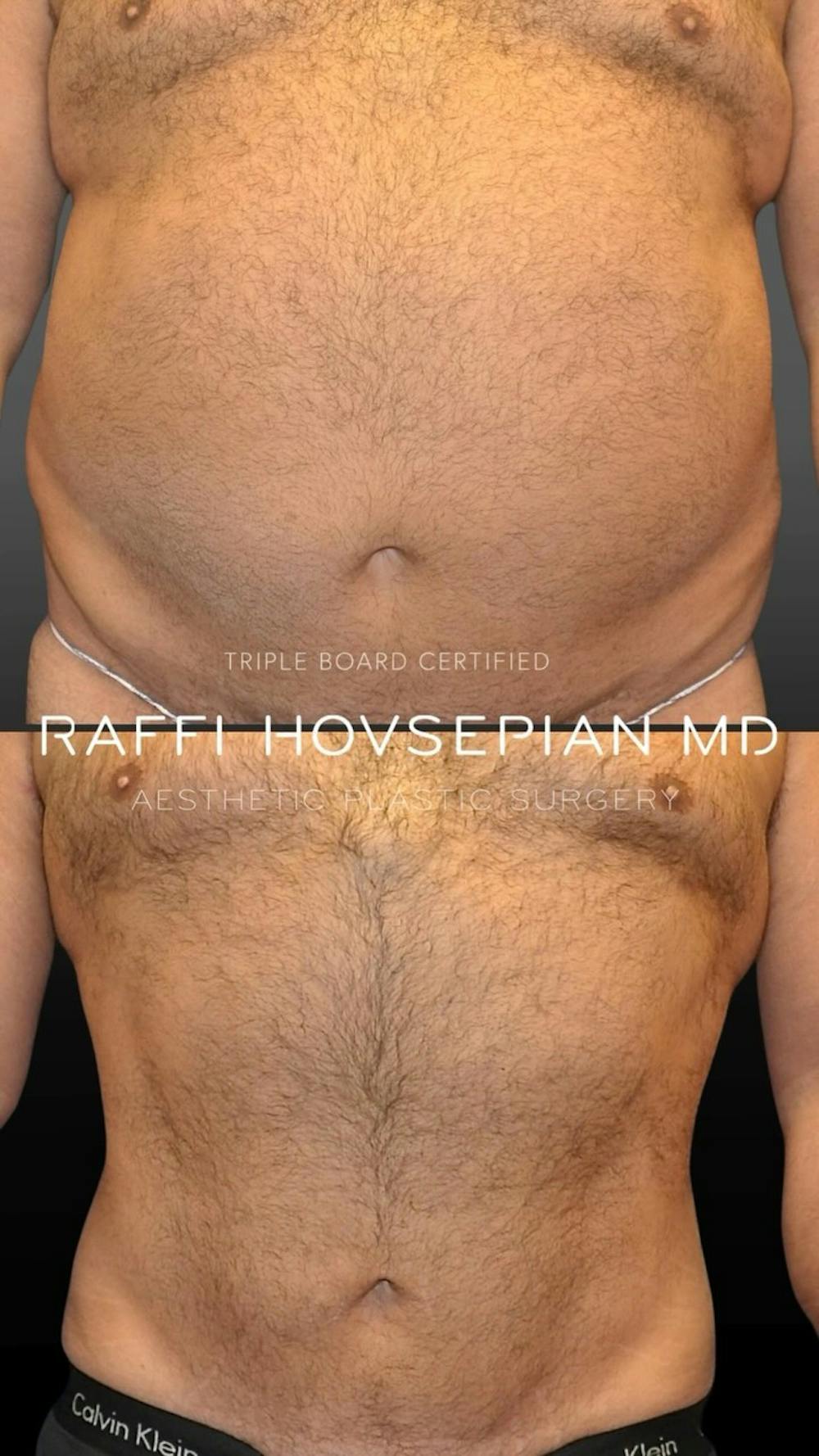 Procedures Before & After Gallery - Patient 189892990 - Image 1