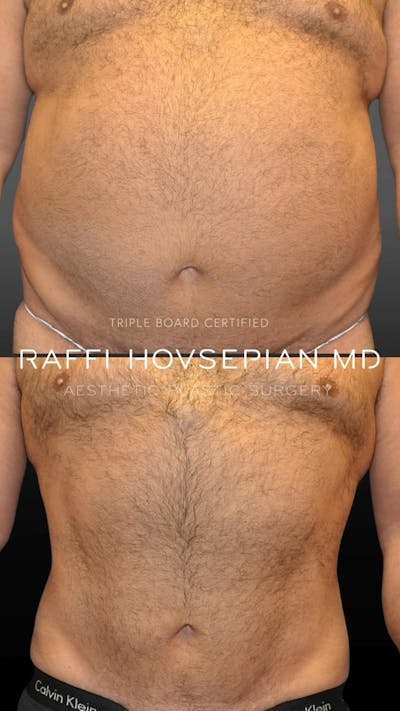 Procedures Before & After Gallery - Patient 189892990 - Image 1