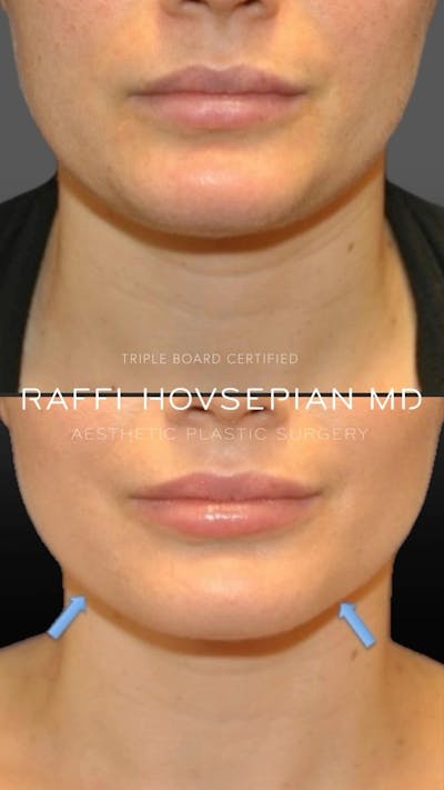 Procedures Before & After Gallery - Patient 146020 - Image 1