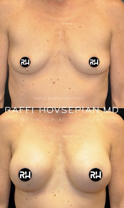 Procedures Before & After Gallery - Patient 216804 - Image 1