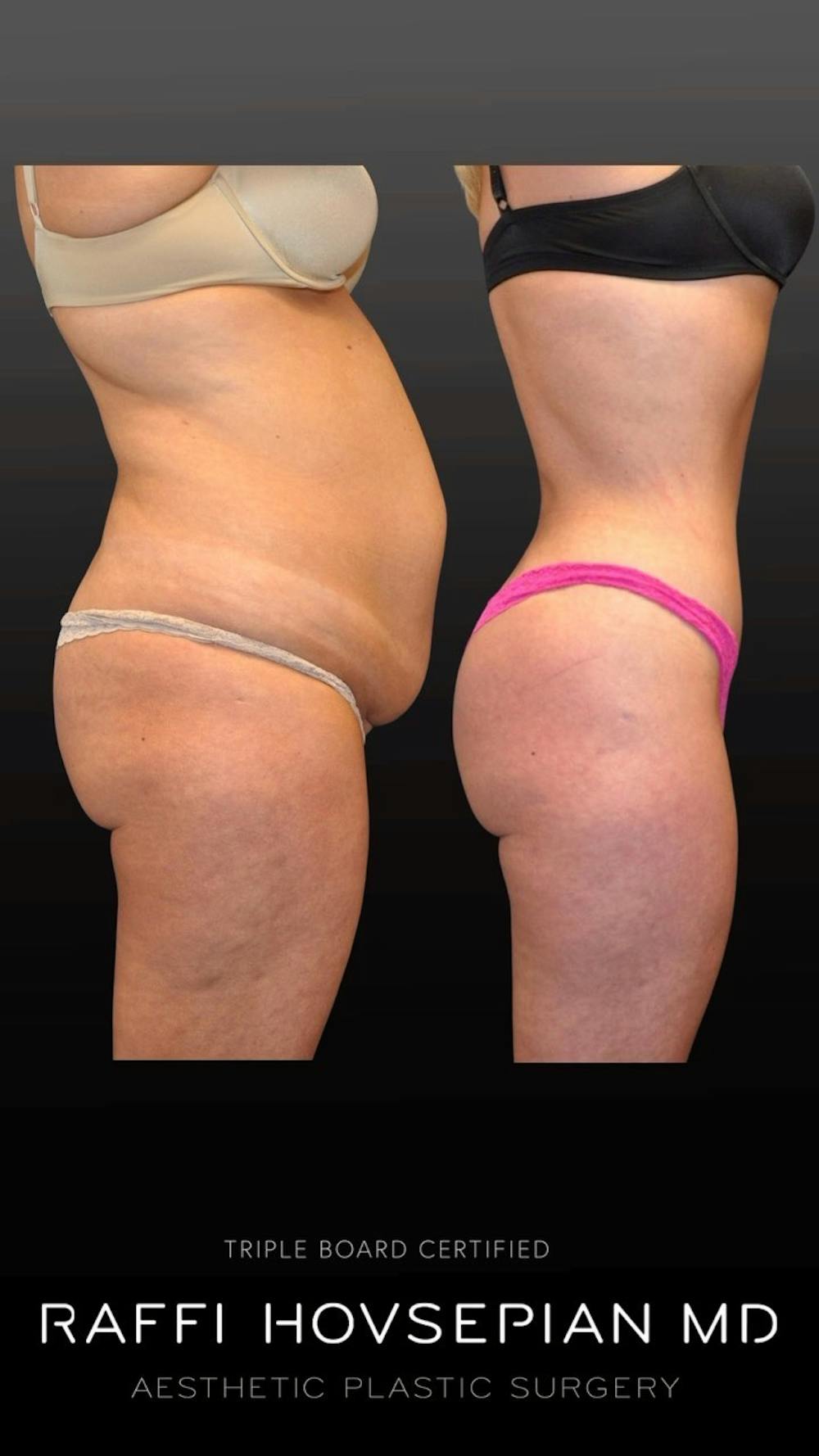 Procedures Before & After Gallery - Patient 228076 - Image 1
