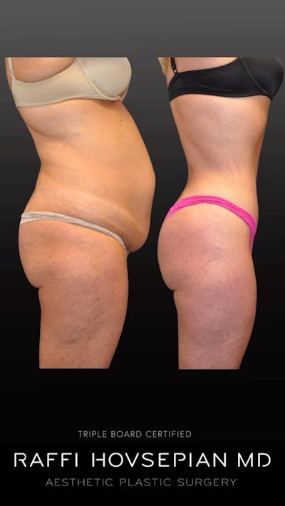 Procedures Before & After Gallery - Patient 228076 - Image 1