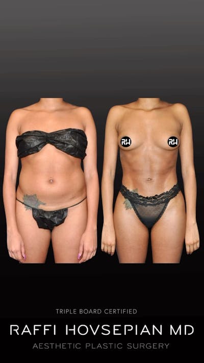 Procedures Before & After Gallery - Patient 262713 - Image 1
