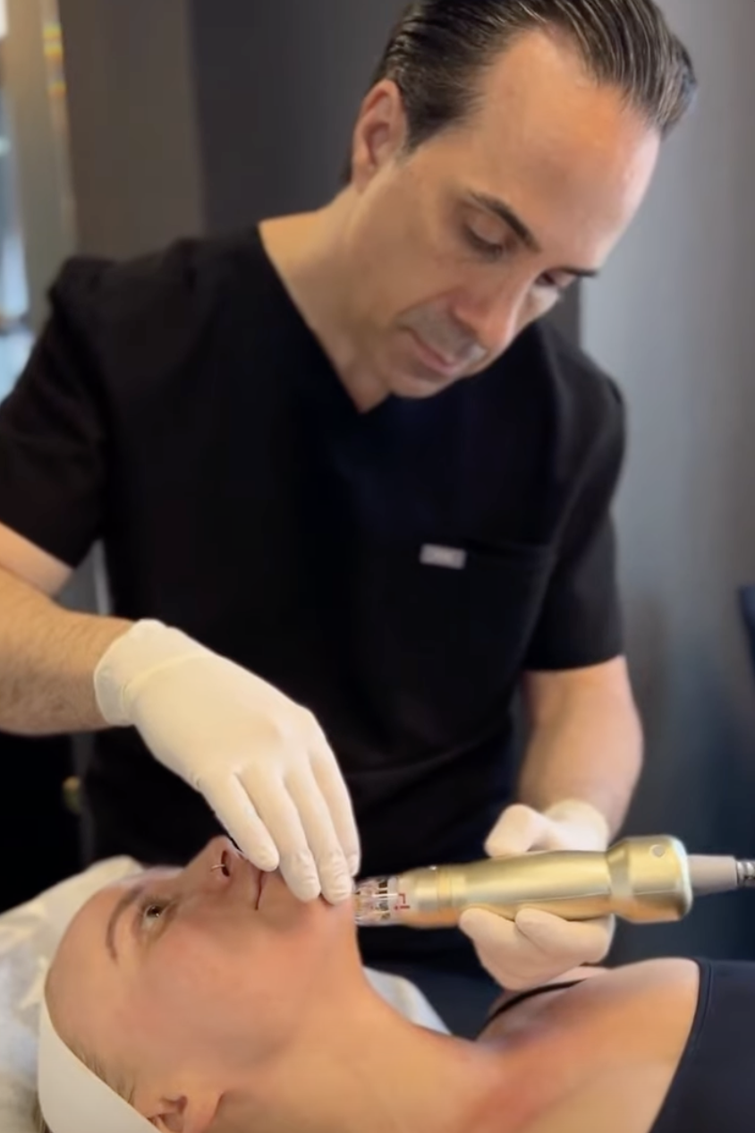 A still from a video of Dr. Hovsepian doing a microneedling treatment