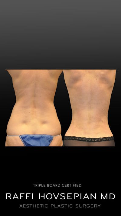 Procedures Before & After Gallery - Patient 422234 - Image 1