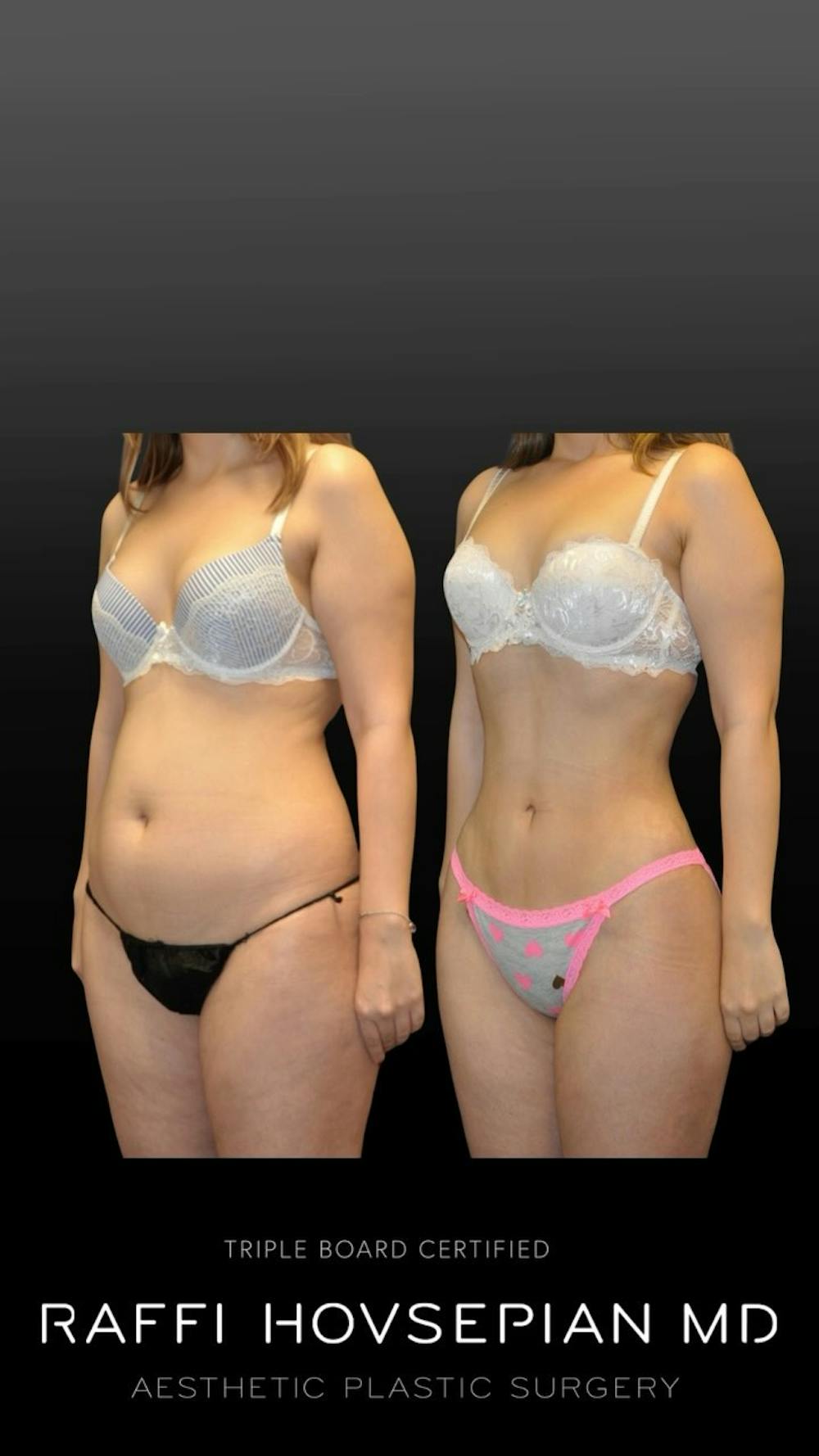 Procedures Before & After Gallery - Patient 367763 - Image 1