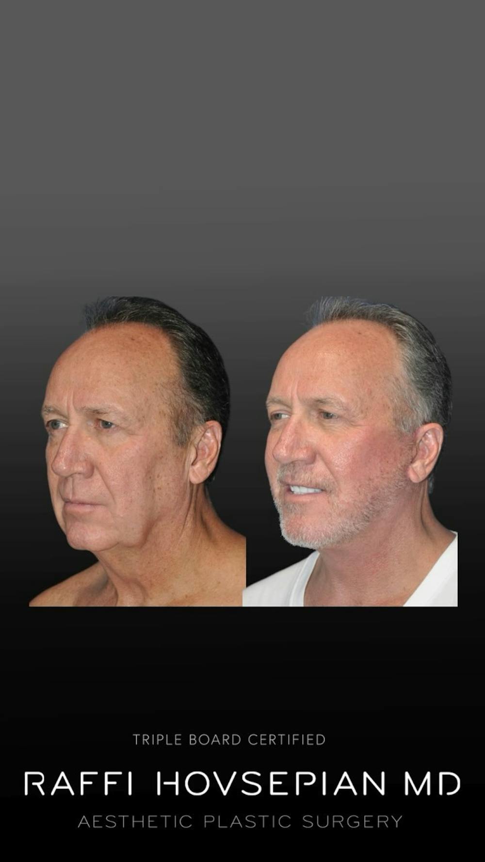Procedures Before & After Gallery - Patient 189892901 - Image 1