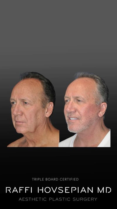 Procedures Before & After Gallery - Patient 189892901 - Image 1