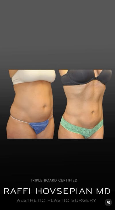 Procedures Before & After Gallery - Patient 243554 - Image 1