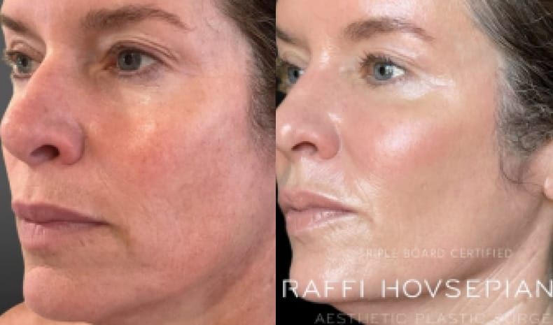 【極美品】Non-Surgical Skin Tightening and Li Non-Surgical Skin Tightening | Raffi Hovsepian MD Aesthetic