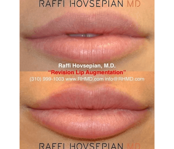 Specialized Fillers