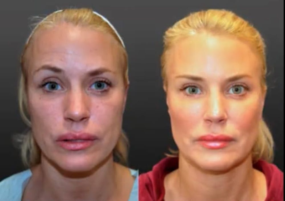 Procedures Before & After Gallery - Patient 189892921 - Image 1