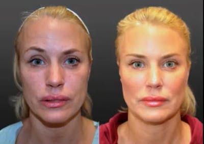 Procedures Before & After Gallery - Patient 189892921 - Image 1