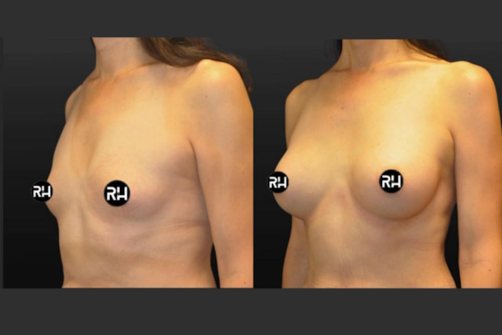 Procedures Before & After Gallery - Patient 125918 - Image 1