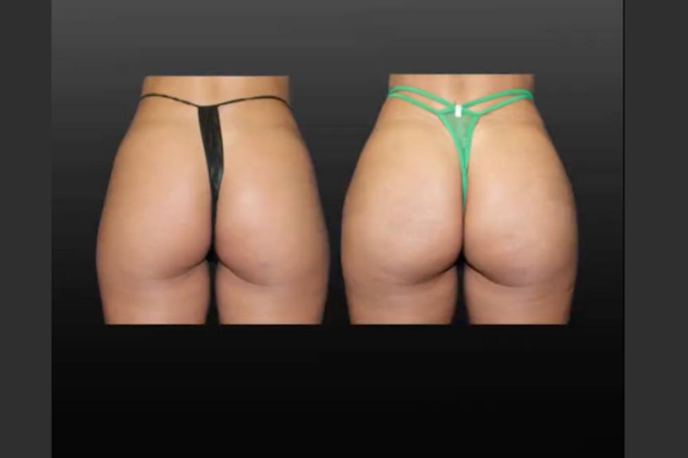 Procedures Before & After Gallery - Patient 536664 - Image 1