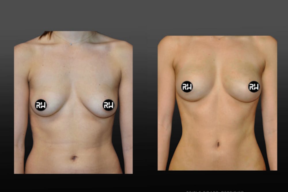 Procedures Before & After Gallery - Patient 122024 - Image 1