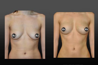 Procedures Before & After Gallery - Patient 122024 - Image 1