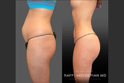 Procedures Before & After Gallery - Patient 530985 - Image 1