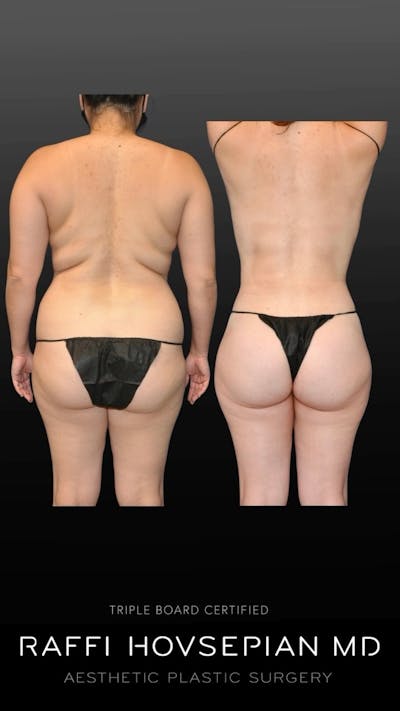 image of a mommy makeover patient