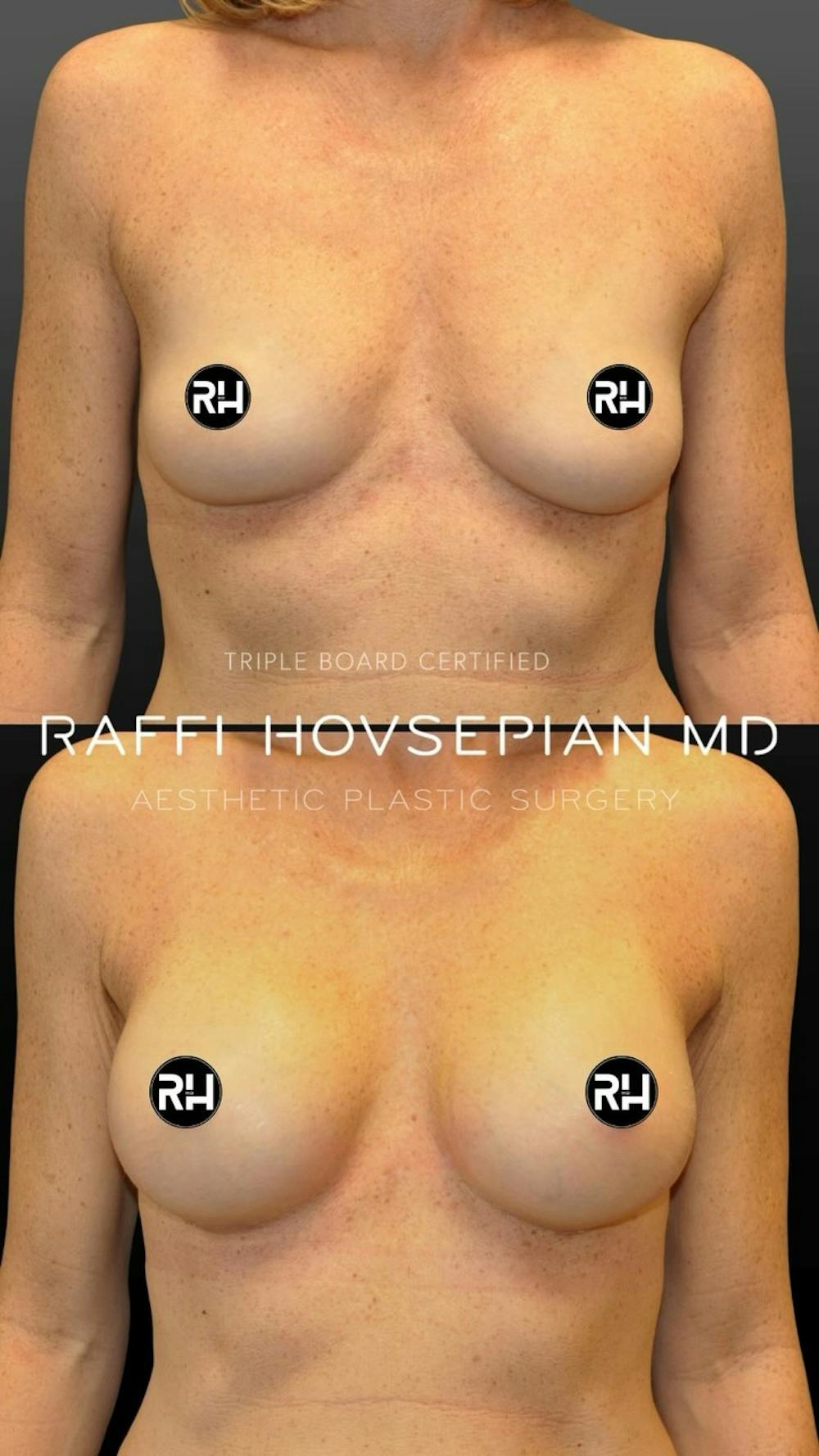 Procedures Before & After Gallery - Patient 899895 - Image 1