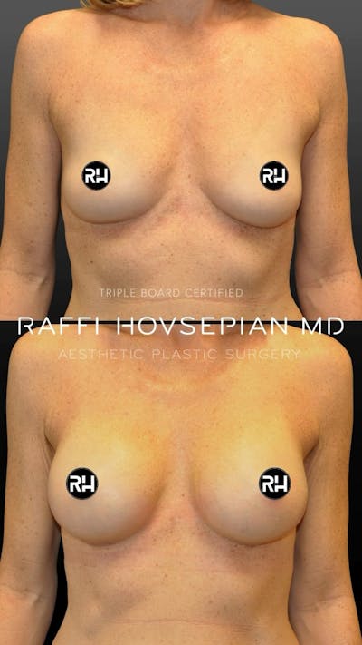 Procedures Before & After Gallery - Patient 899895 - Image 1