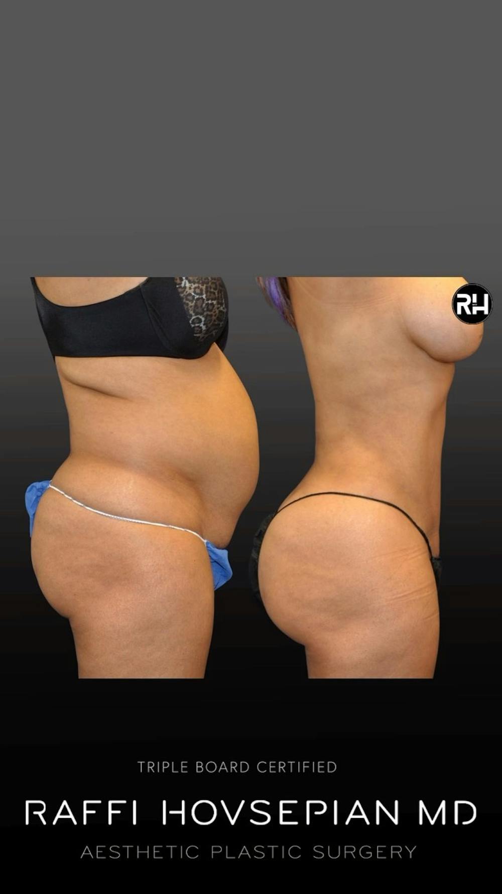 Procedures Before & After Gallery - Patient 143377 - Image 1