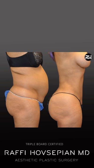 Procedures Before & After Gallery - Patient 143377 - Image 1