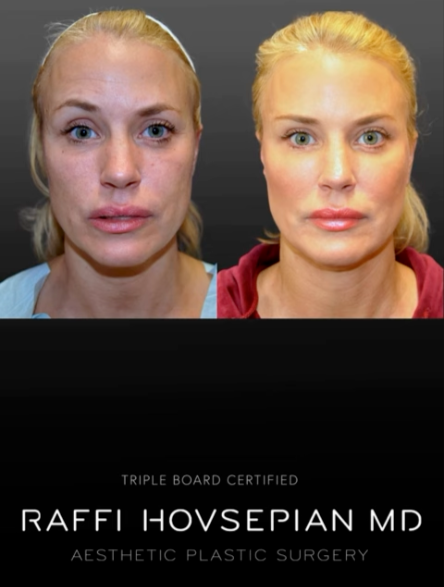 A still from a video of Dr. Hovsepian with a Sculptra patient
