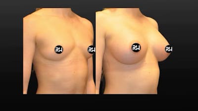 Procedures Before & After Gallery - Patient 355074 - Image 1