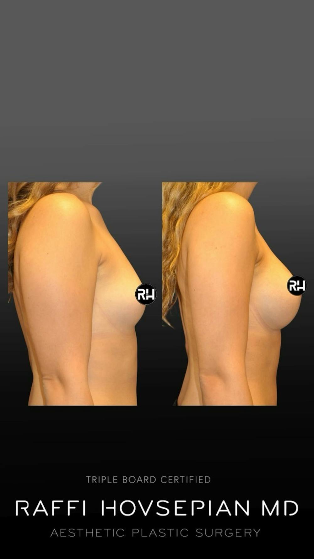 Procedures Before & After Gallery - Patient 121810 - Image 1