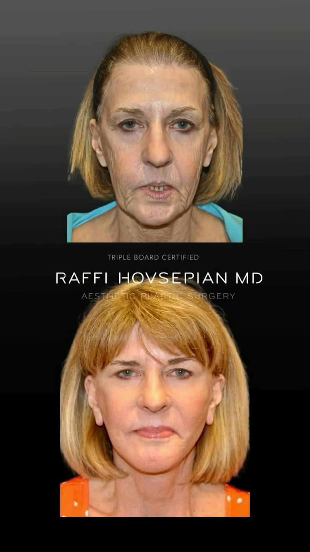 Procedures Before & After Gallery - Patient 323643 - Image 1