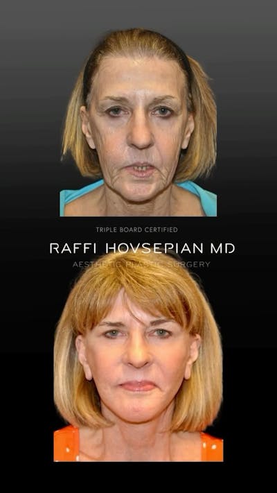 Procedures Before & After Gallery - Patient 323643 - Image 1