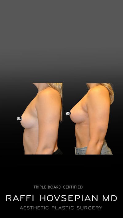 Procedures Before & After Gallery - Patient 206866 - Image 1