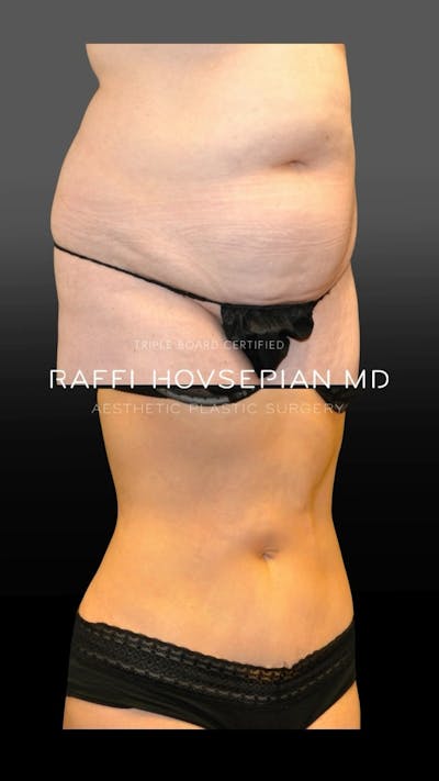 Procedures Before & After Gallery - Patient 126392 - Image 1
