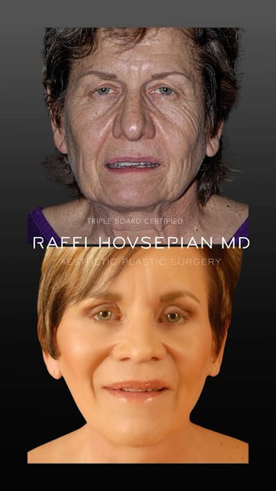 Procedures Before & After Gallery - Patient 158445 - Image 1