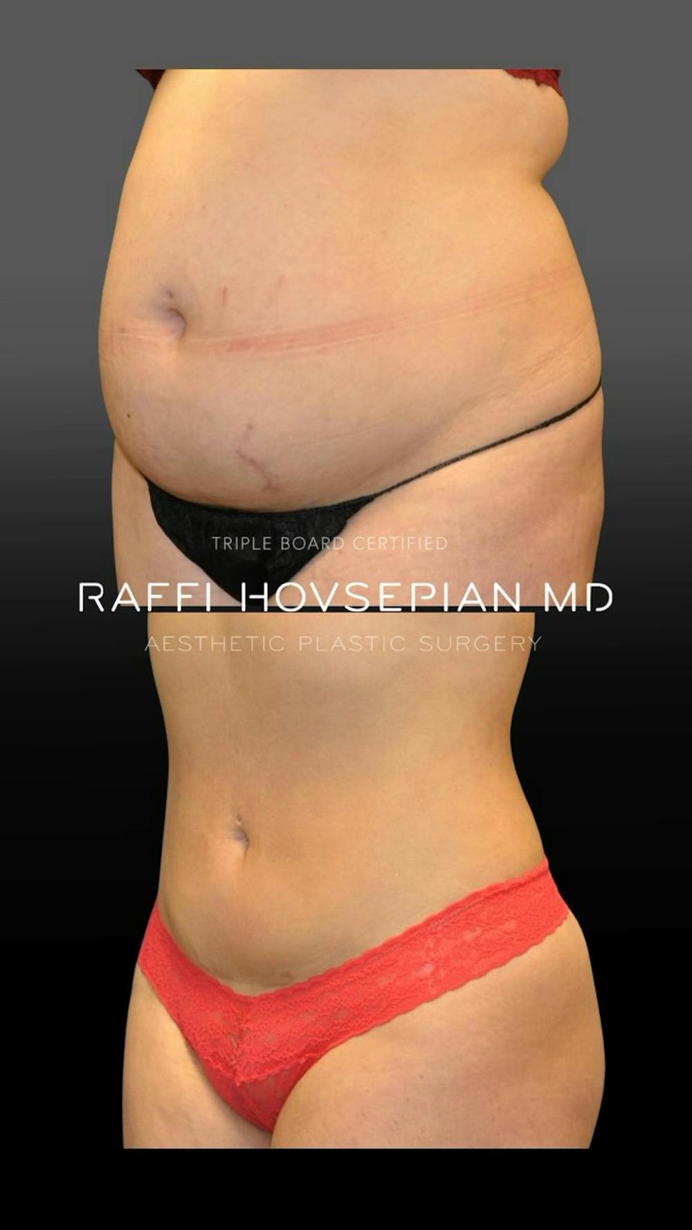 Procedures Before & After Gallery - Patient 852514 - Image 1
