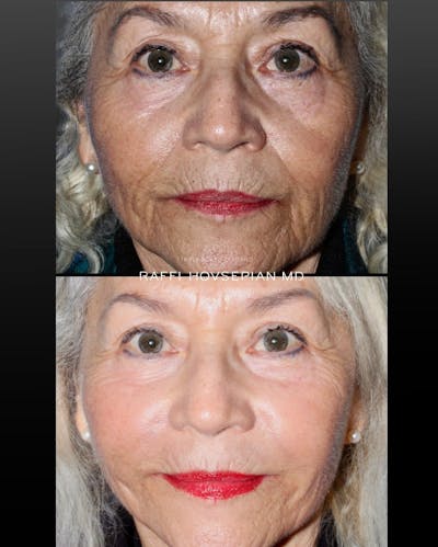 Procedures Before & After Gallery - Patient 150736 - Image 1