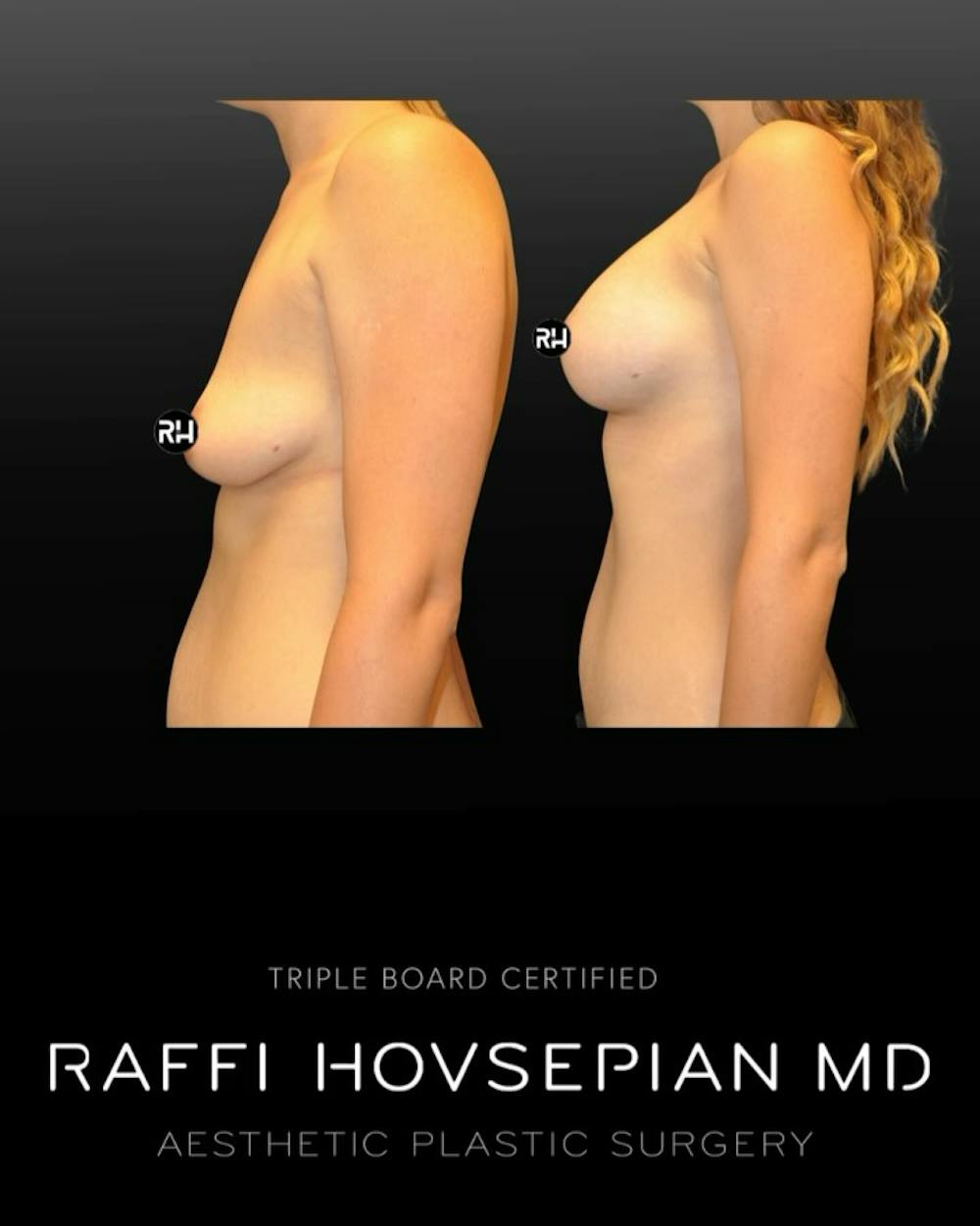 Procedures Before & After Gallery - Patient 188474 - Image 1