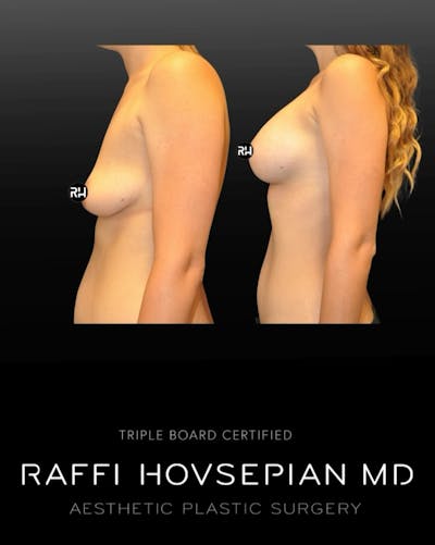 Procedures Before & After Gallery - Patient 188474 - Image 1