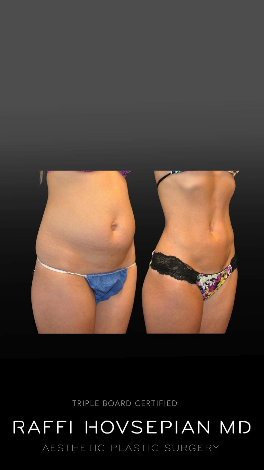 Procedures Before & After Gallery - Patient 325765 - Image 1