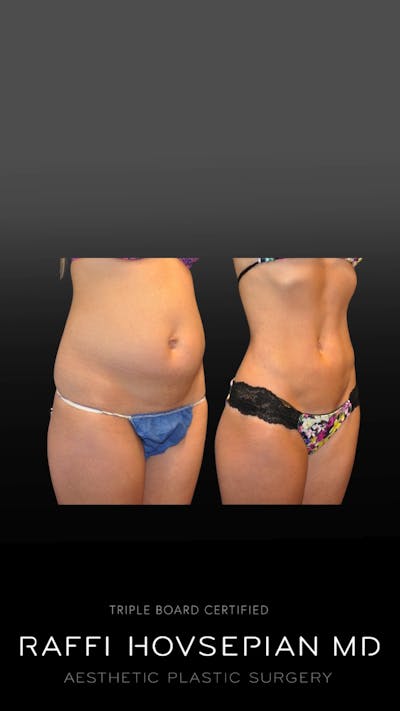 Procedures Before & After Gallery - Patient 325765 - Image 1