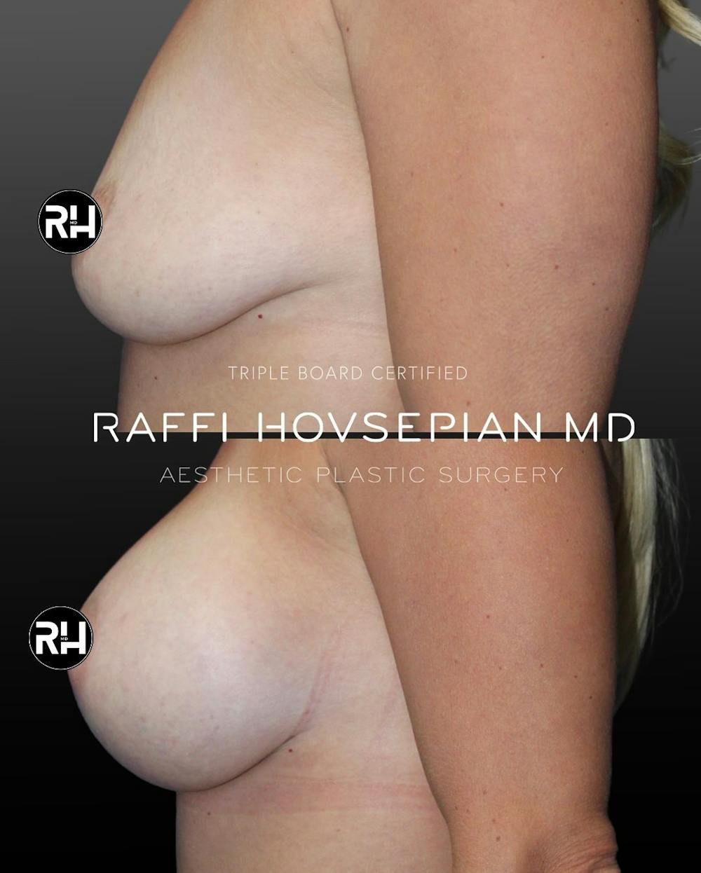 Procedures Before & After Gallery - Patient 331963 - Image 1