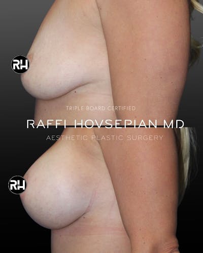 Procedures Before & After Gallery - Patient 331963 - Image 1