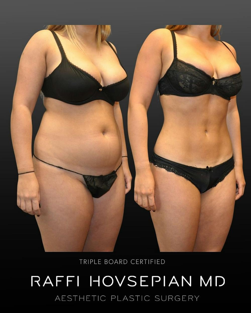 Procedures Before & After Gallery - Patient 984854 - Image 1