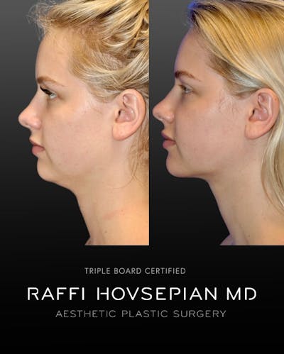 Procedures Before & After Gallery - Patient 543203 - Image 1