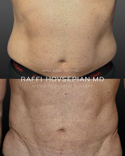 Procedures Before & After Gallery - Patient 162128 - Image 1