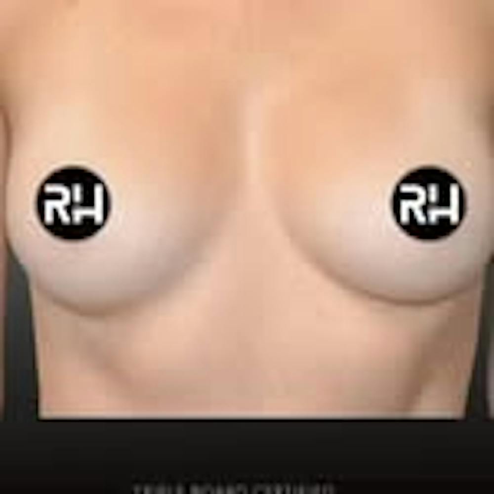 Procedures Before & After Gallery - Patient 124827 - Image 2