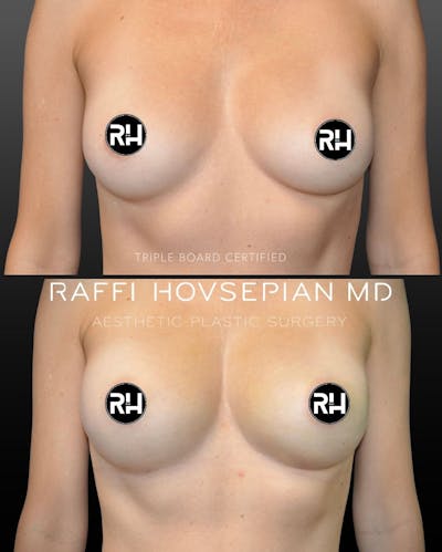Procedures Before & After Gallery - Patient 124827 - Image 1